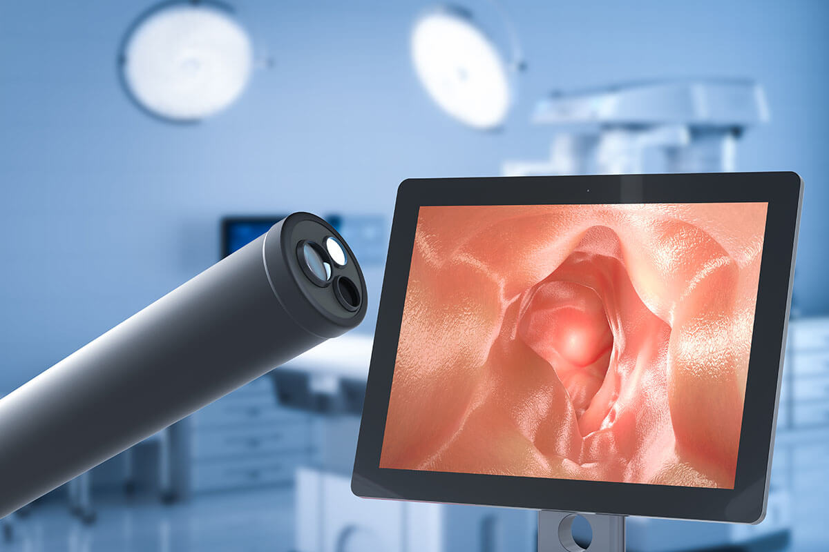 Screening del tumore del colon nelle IBD