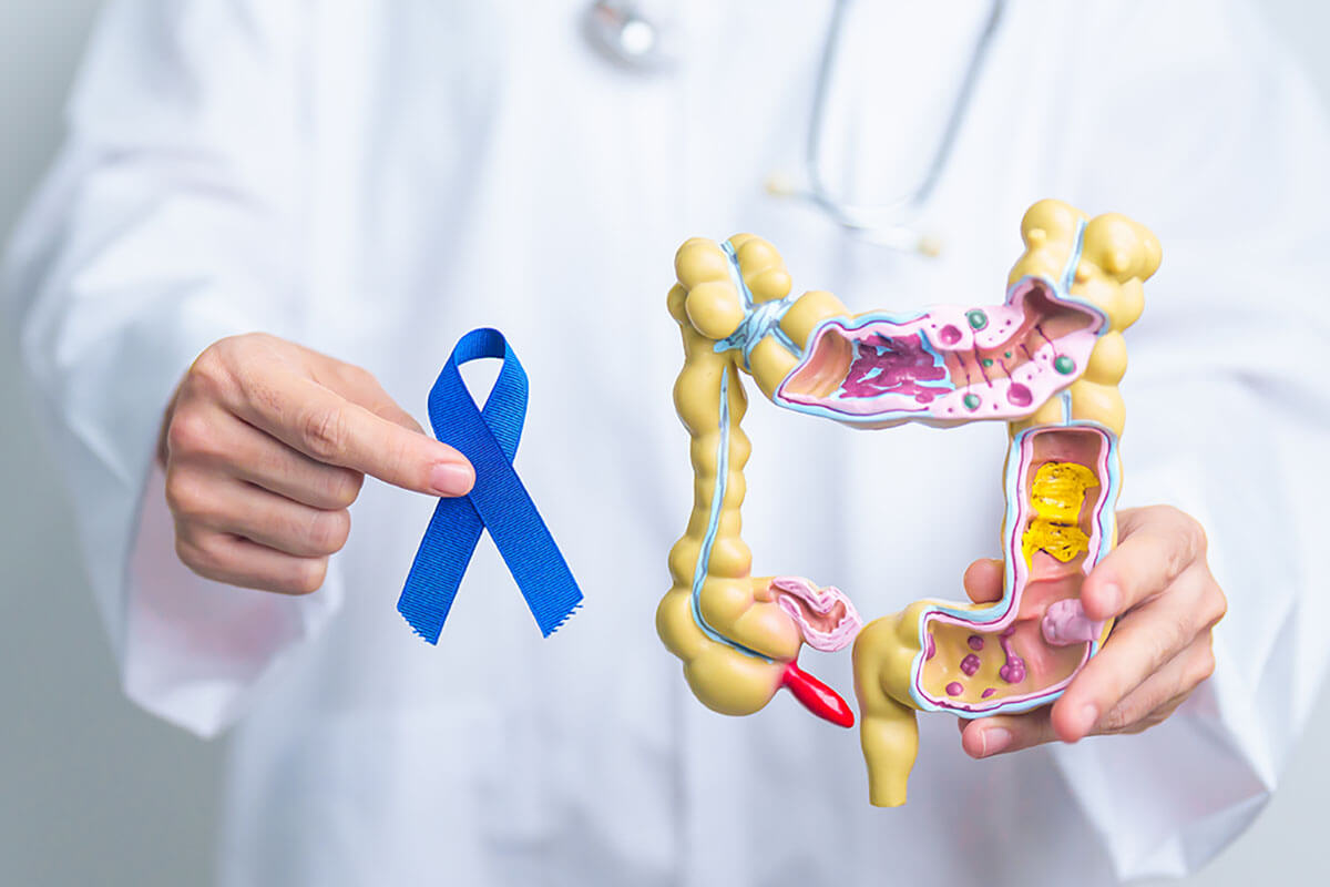 Screening del tumore del colon nelle IBD